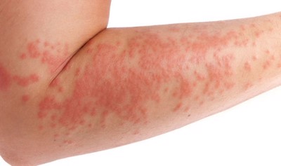 Các thể bệnh eczema và nguyên nhân gây ra là gì?